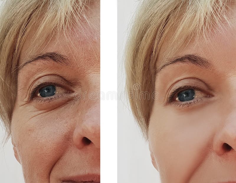 woman-wrinkles-face-health-regeneration-result-treatment-cosmetic-procedures-woman-wrinkles-face-126429286